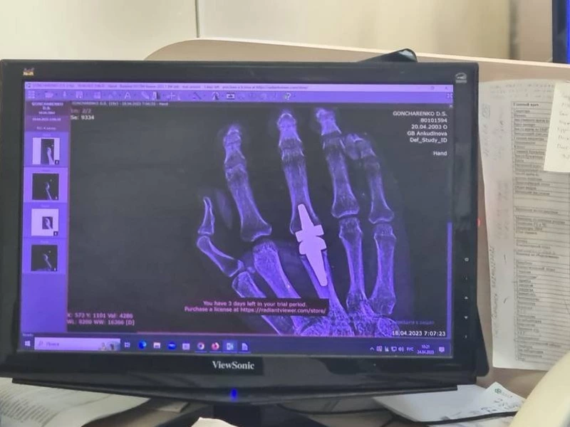 Эндопротезирование суставов кисти стало возможным на Сахалине